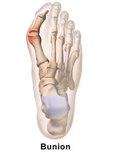 Bunions and hammer toes