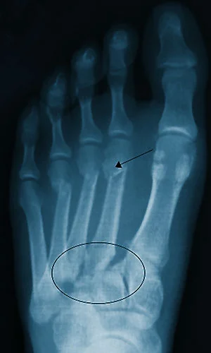 Foot injury Work injury