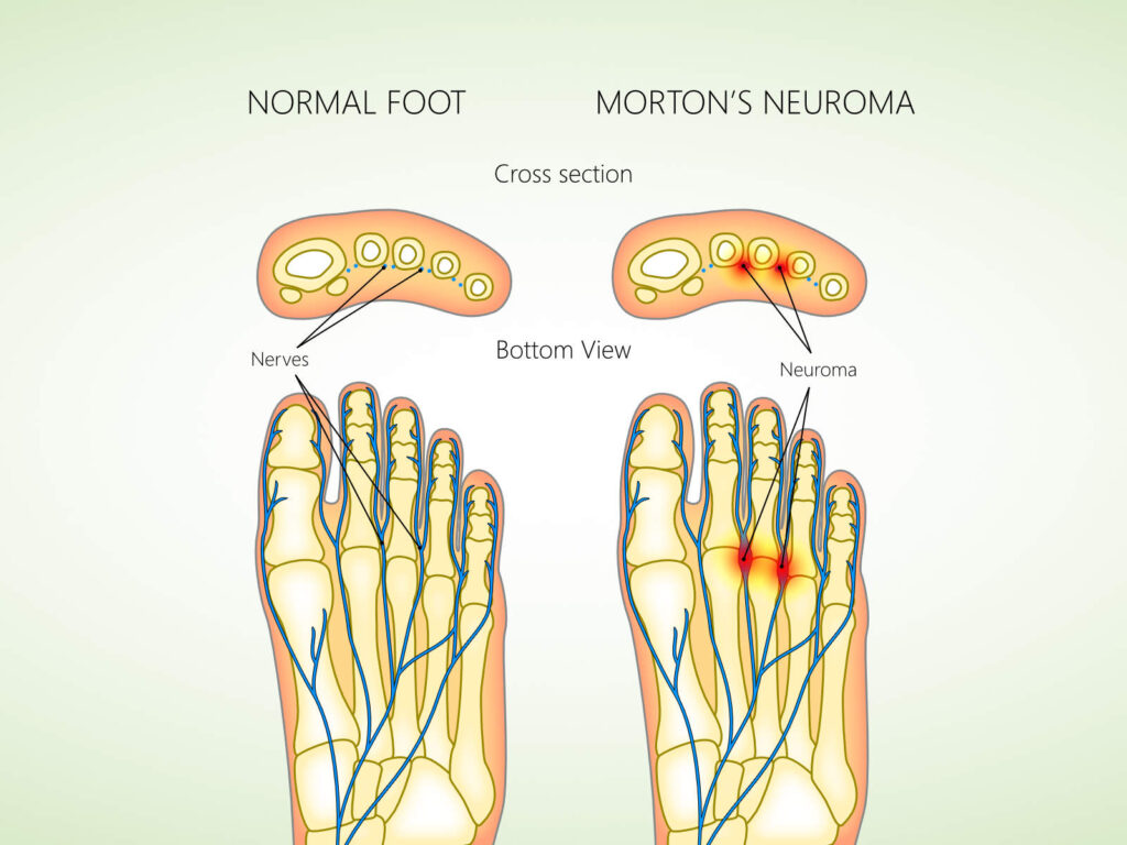 Nerve conditions