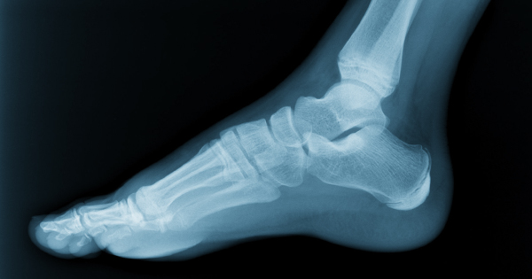 Sever's Disease